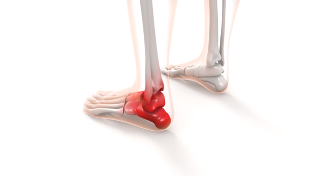 捻挫｜骨｜透明/赤色｜人間ドック/MRI｜脳/ブレイン - 医療/病気/介護/病院/人物/写真/イラスト/無料ダウンロード