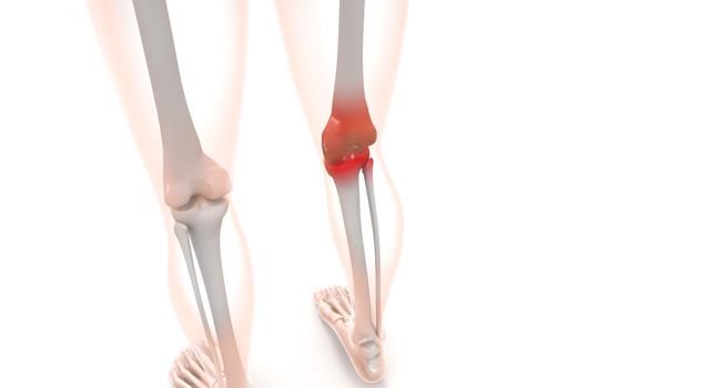 擦り減って痛む｜膝｜膝関節症/しつかんせつしょう｜治療/手術｜赤く腫れる/炎症 - 医療/病気/介護/病院/人物/写真/イラスト/無料ダウンロード