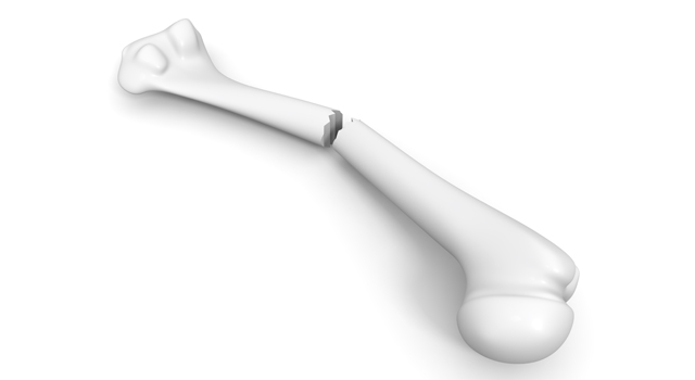 骨｜折れる｜事故/治療｜心臓/肺/健康｜血液/検査 - 医療/病気/介護/病院/人物/写真/イラスト/無料ダウンロード