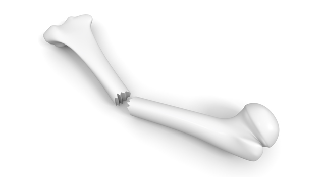 砕ける｜骨｜折れる/ひび｜食欲/睡眠/薬｜手術台/ドクター - 医療/病気/介護/病院/人物/写真/イラスト/無料ダウンロード